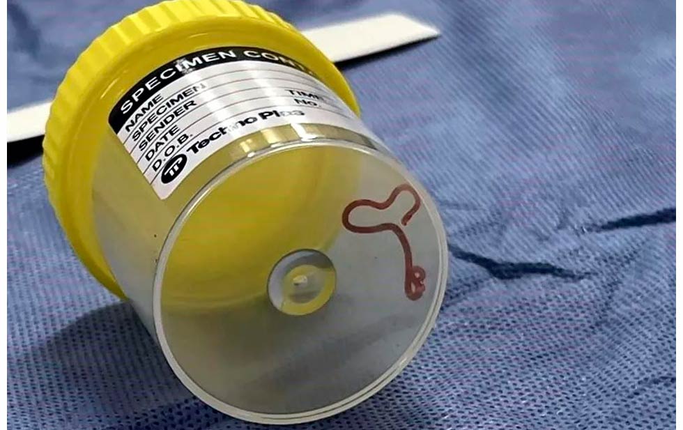 Extraen gusano del cerebro de una mujer en Australia