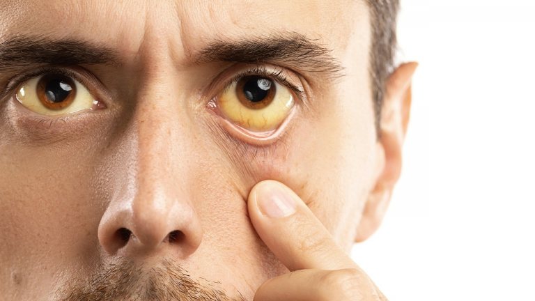 Descartan incremento de casos de Hepatitis A