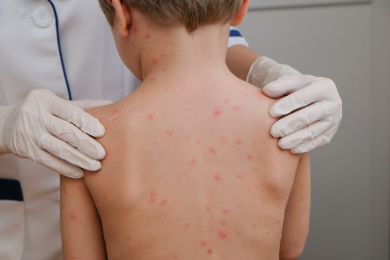 Suma sarampión más de 6 mil casos durante este año