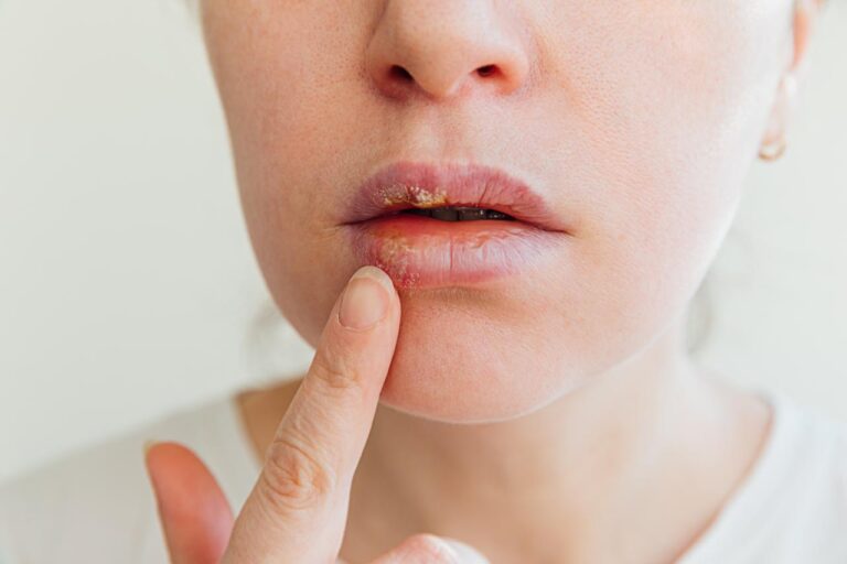 Emite SSZ recomendaciones para tratar herpes labial