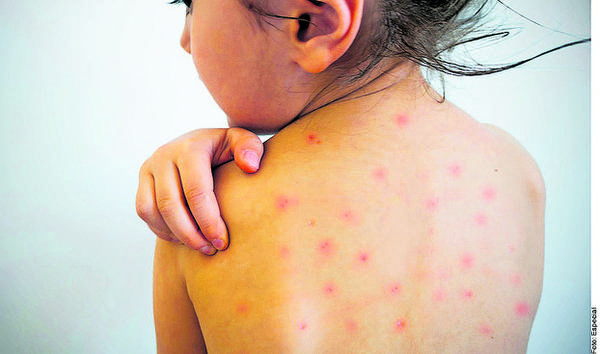 Acumula estado 299 casos de sarampión